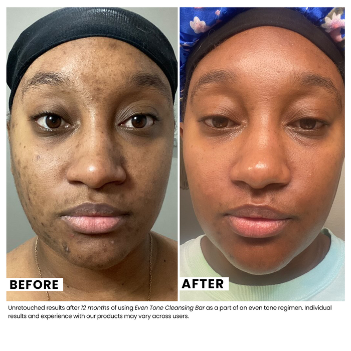 Woman's skin before and after using USRx Even Tone Cleansing Bar